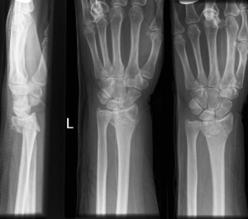 Distal-radius-Colles-fractures – OrthoPaedia