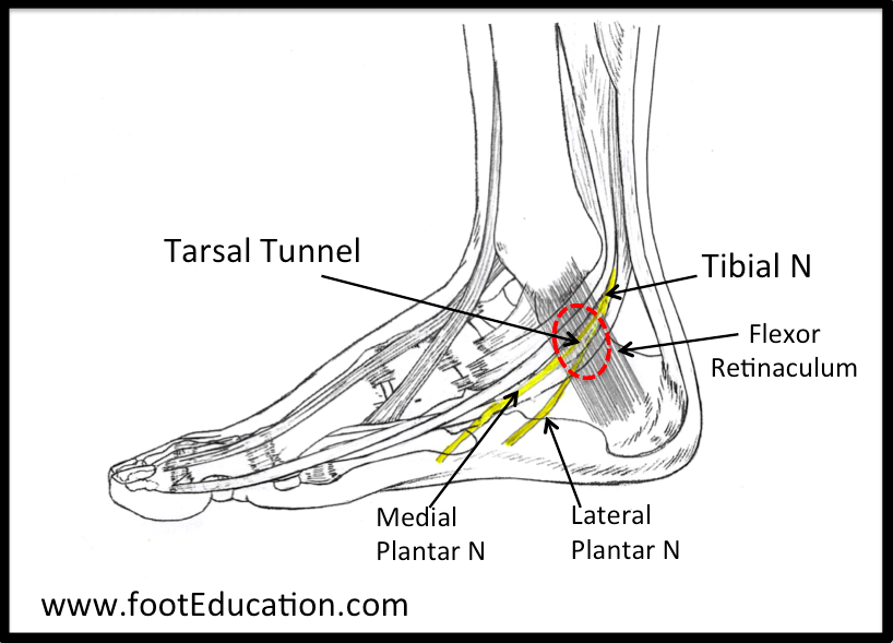 Tarsal-Tunnel-Syndrome – OrthoPaedia