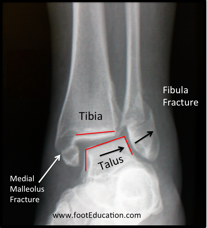 Ankle-Fractures – OrthoPaedia