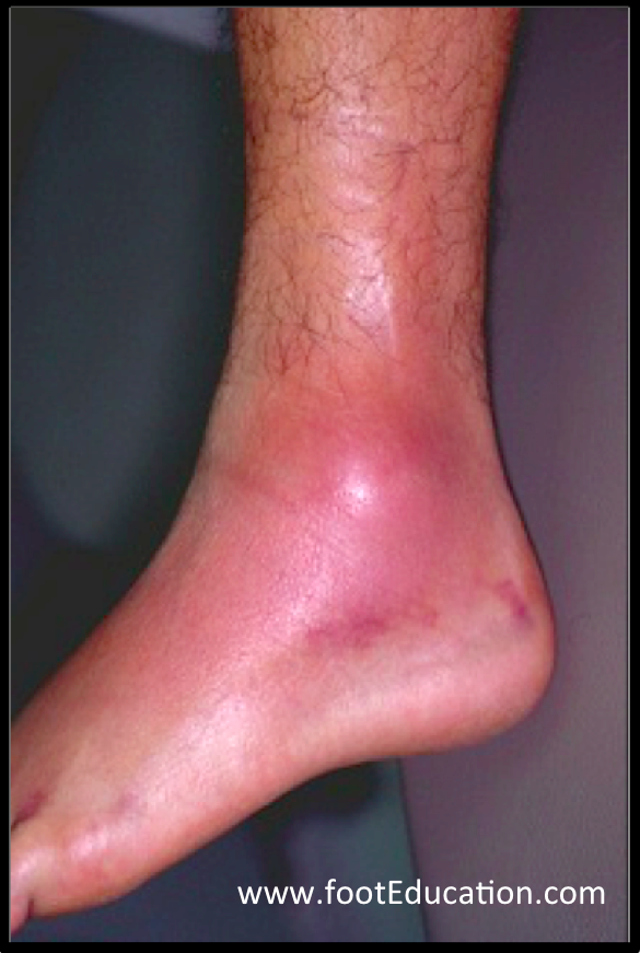 How to treat an eversion ankle sprain 