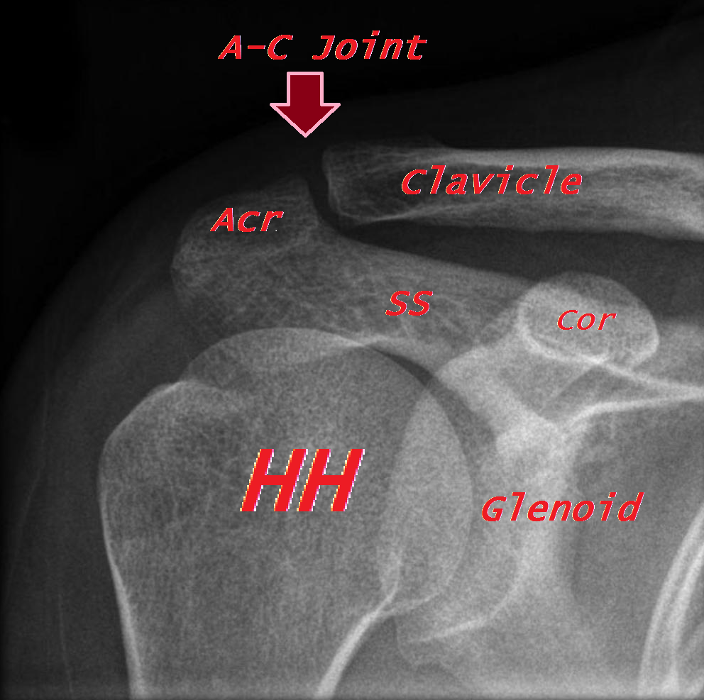 Disorders-of-the-Acromioclavicular-Joint – OrthoPaedia